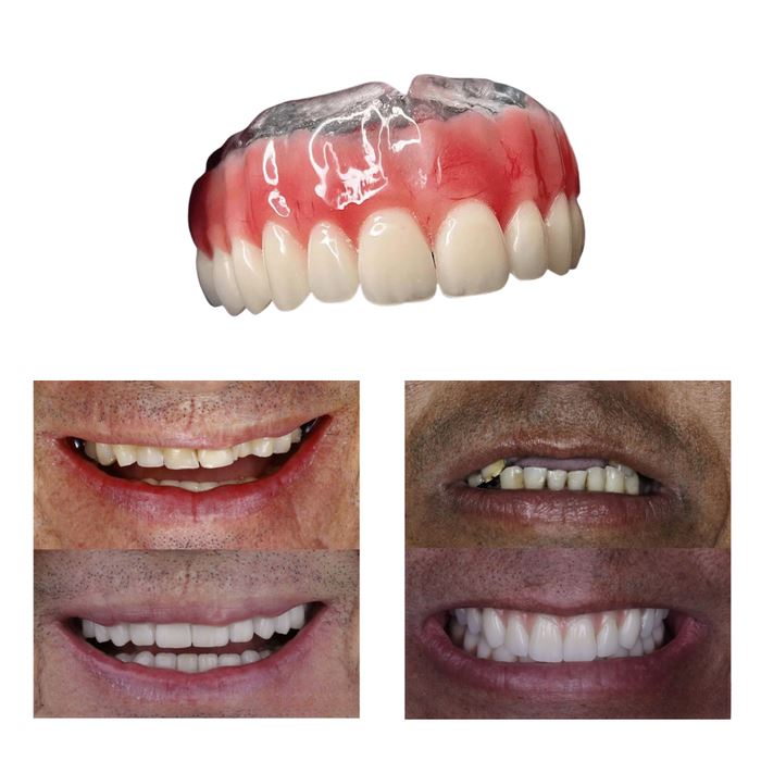 (2 POUR LE PRIX D’1) Dentier en silicone FIX | Ajustable et adaptatif + Kit de nettoyage OFFERT