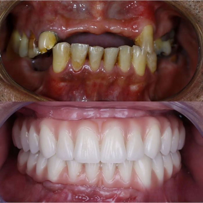(2 POUR LE PRIX D’1) Dentier en silicone FIX | Ajustable et adaptatif + Kit de nettoyage OFFERT